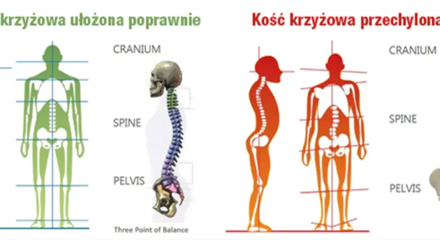 Prawidłowe ułożenie kości krzyżowej zapewnia stabilność kręgosłupa. Po prawej widać skrzywienie, gdzie kość krzyżowa jest przechylona.