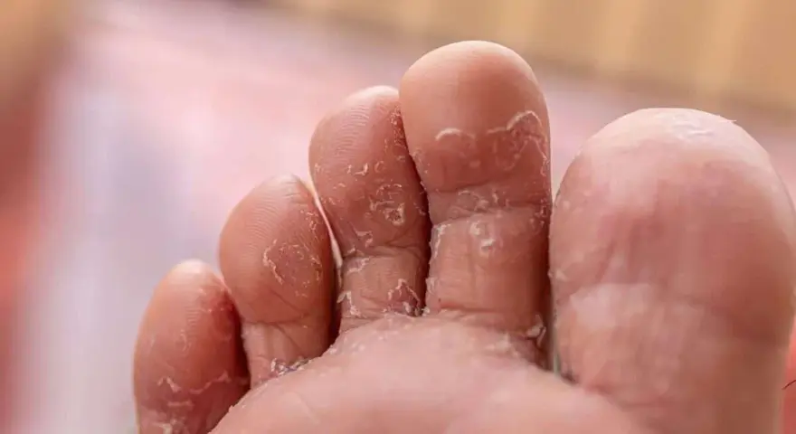 Close-up of toes with peeling skin, a common symptom of athlete's foot. Many wonder if Epsom salt is good for athlete's foot.