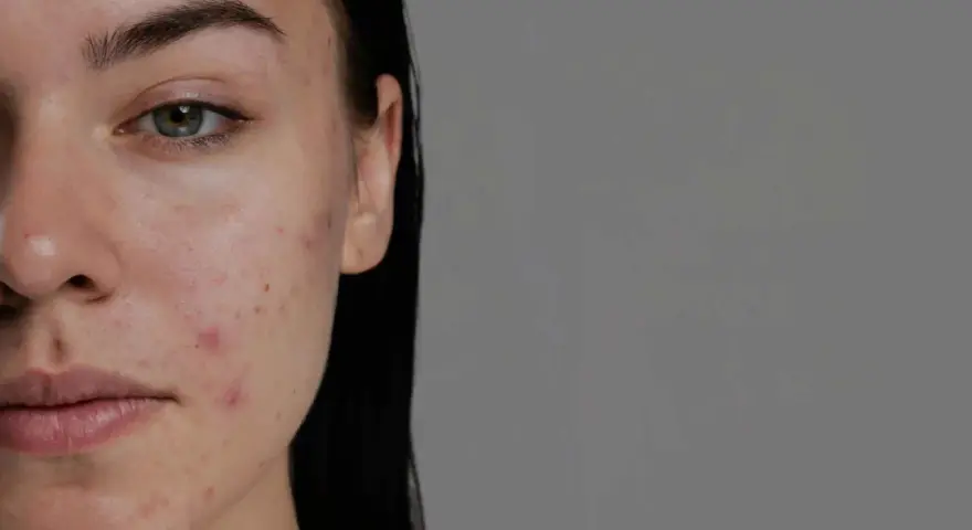 Primo piano del viso di una giovane donna con brufoli e rossori. L'acido ialuronico può aiutare a migliorare l'aspetto della pelle.