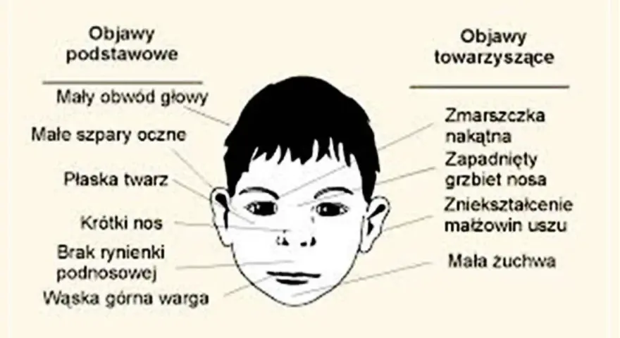 Ilustracja twarzy dziecka z opisem objawów. Co to znaczy? Mały obwód głowy, płaska twarz, krótki nos, wąska warga, zmarszczka nakątna, zapadnięty grzbiet nosa.