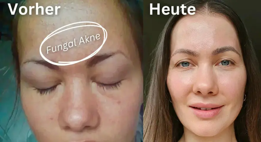 Vorher: Haut mit Rötungen und Pickelchen, gekennzeichnet als "Fungal Akne". Heute: Klare, strahlende Haut.