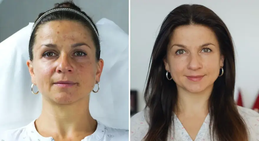 Przed i po zabiegu: skóra z niedoskonałościami i przebarwieniami staje się gładka i promienna. Fibryna pod oczy zdziałała cuda!