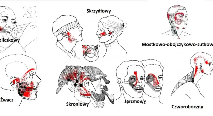 Punkty spustowe w obrębie stawów skroniowo żuchwowych: policzkowy, skrzydłowy, żwacz, skroniowy, jarzmowy, mostkowo-obojczykowo-sutkowy, czworoboczny.