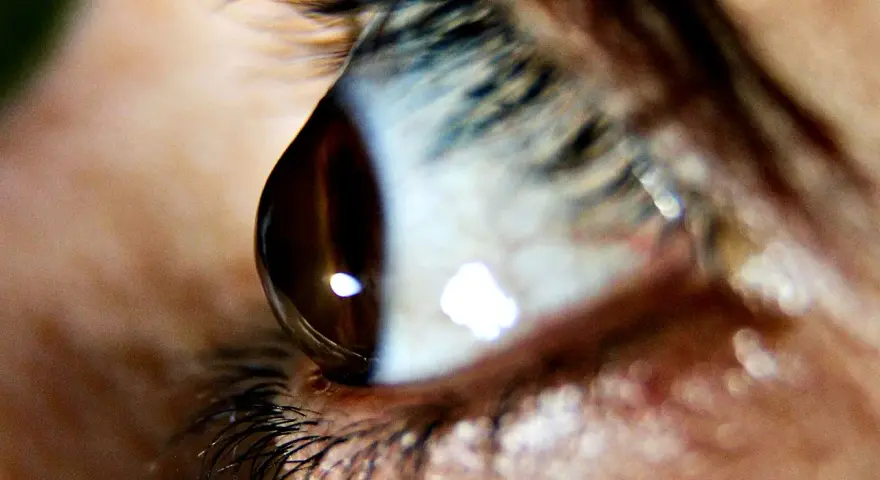 Occhio umano con riflessi luminosi. Il cheratocono è ereditario, una condizione che può colpire la vista.