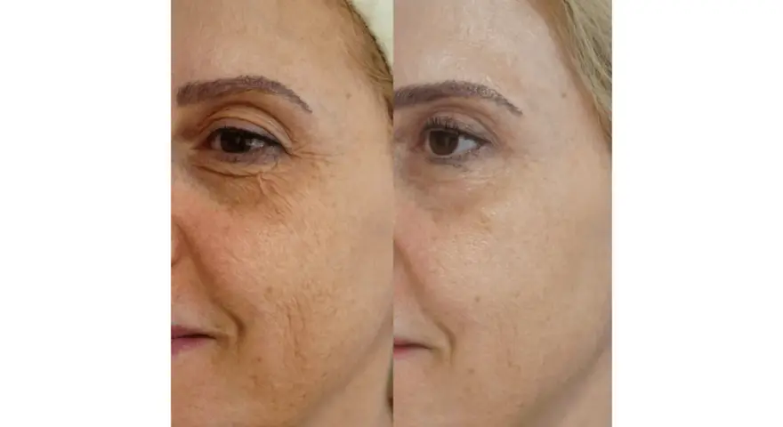 Vorher-nachher-Vergleich der Haut einer Frau: Deutliche Reduzierung von Falten und Pigmentflecken nach Anwendung von Retinol.