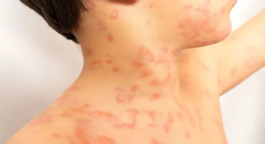 Primer plano de sarpullidos en la piel de un niño, con manchas rojas y elevadas en el cuello y el hombro.