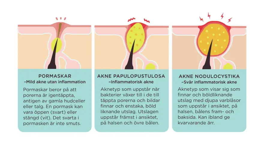 Illustrationer visar hur man får finnar: pormaskar, inflammatorisk akne och svår akne.