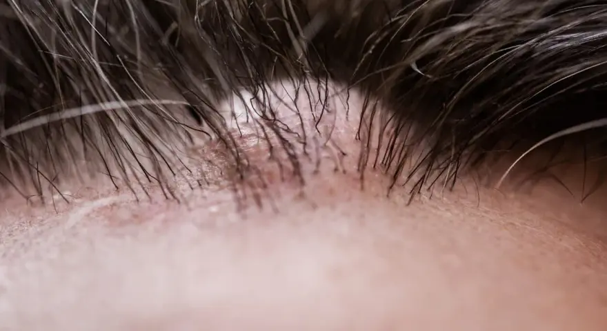 Primo piano della pelle con capelli scuri e una protuberanza sulla fronte, forse un brufolo o un piccolo neo.