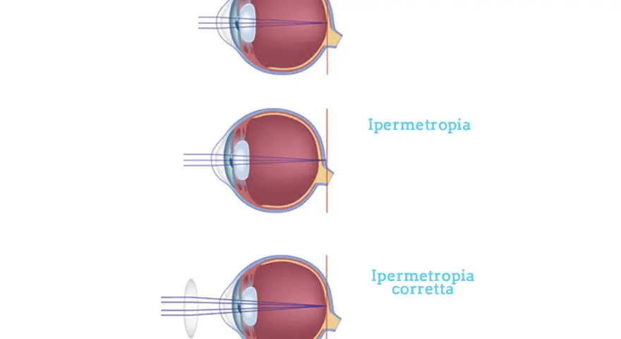 Illustrazione dell'ipermetropia oculare: visione normale, ipermetropia e correzione con lente.