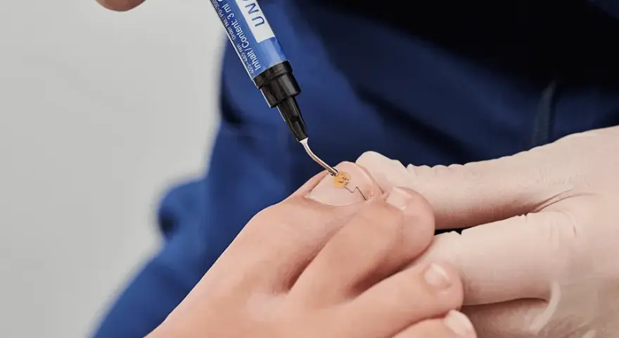 Jak zerwać paznokieć bez bólu? Skuteczne metody i porady