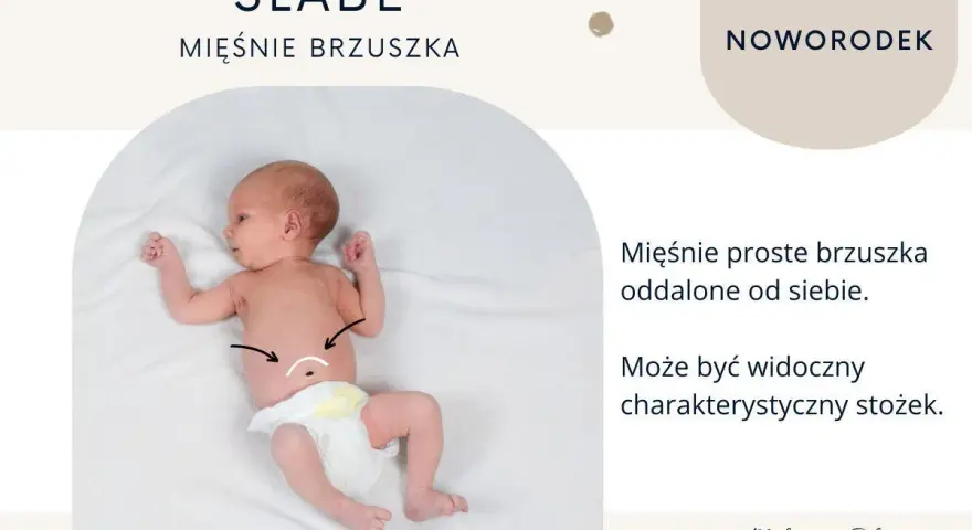Noworodek z widocznym, wzdętym brzuchem. Mięśnie proste brzuszka są oddalone, tworząc charakterystyczny stożek.