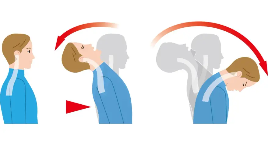 Illustration zeigt die Bewegung des Kopfes bei einem Schleudertrauma.