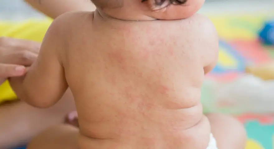 Plecy niemowlęcia pokryte drobną, czerwoną wysypką, przypominającą różyczkę. Mama martwi się o zdrowie maluszka.