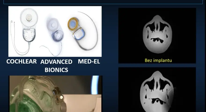 Nowoczesne implanty ślimakowe, w tym niewidoczny implant, poprawiają słuch.
