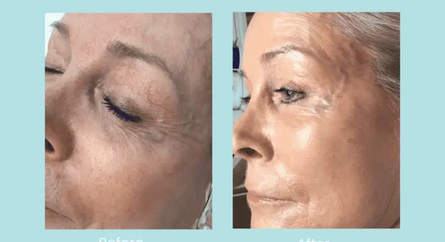 Before and after images show a woman's face. The "before" side displays dehydrated, dull skin with visible wrinkles. The "after" side reveals plump, hydrated, and radiant skin.