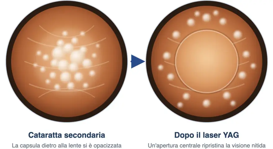 Prima e dopo il laser YAG: la capsula opacizzata della cataratta secondaria viene trattata con un barrage laser retina per ripristinare la visione nitida.