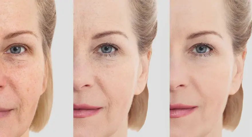 Comparaison avant/après : peau marquée par le temps, puis lissée grâce à l'acide hyaluronique sur le front et le visage.