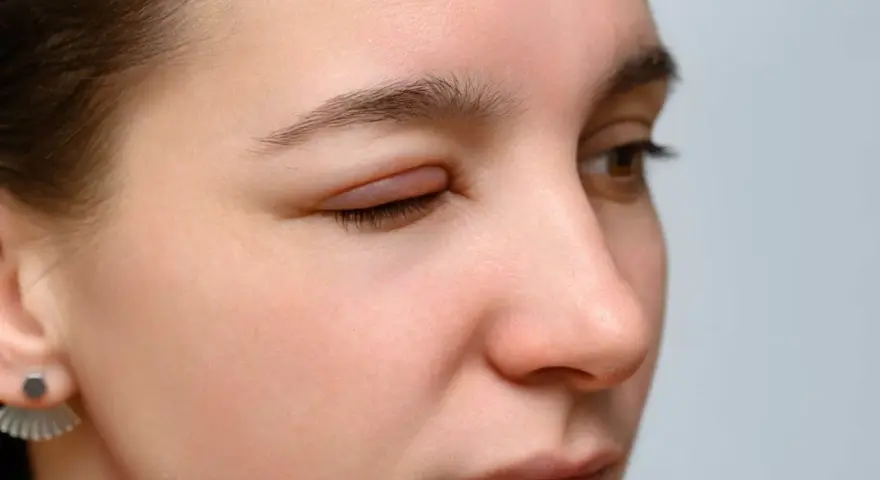 Occhi rossi e gonfi, forse per una reazione allergica. La palpebra è visibilmente gonfia e irritata.