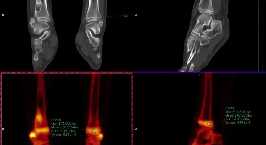 Co to jest SUV max i dlaczego jest kluczowy w diagnostyce medycznej