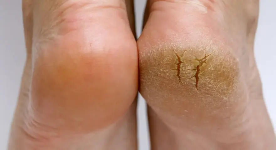 Gros plan sur deux talons, l'un sain et l'autre très sec, craquelé, montrant la différence de texture.