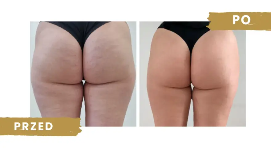 Endermologia: Jak działa, efekty, cena i wskazania poznaj wszystko