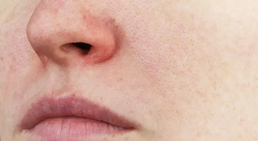 Gros plan sur un visage, avec un nez rouge froid, des lèvres fines et une peau marquée par les pores.