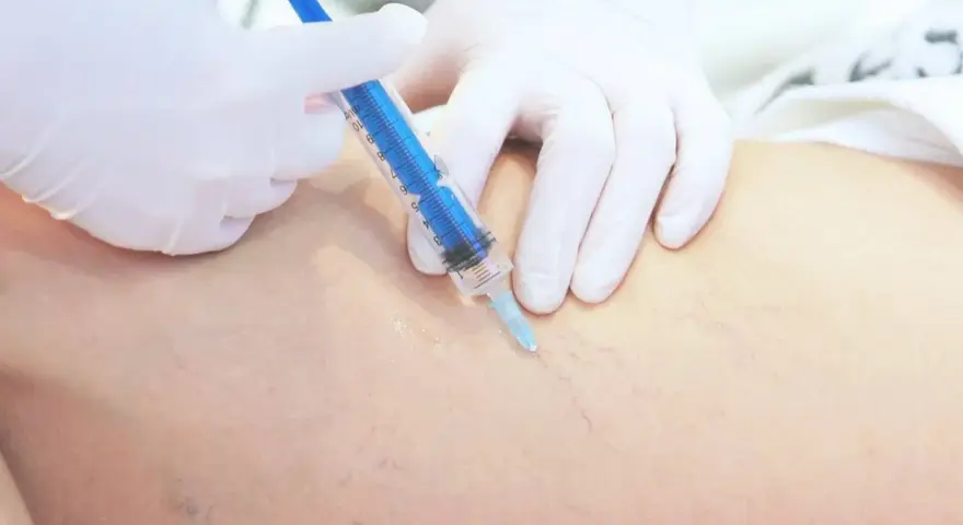 Lekarz w białej rękawiczce wykonuje zastrzyk strzykawką w nogę z widocznymi naczynkami. To skleroterapia żylaków opinie.