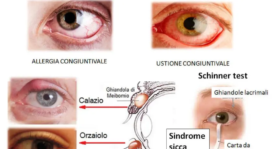 Occhio rosso che lacrima per allergia, ustione, calazio, orzaiolo e sindrome sicca. Test di Schirmer con carta da filtro.