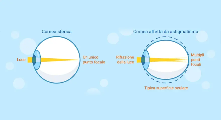 Diagramma mostra come vede un astigmatico: la luce si focalizza in più punti invece che in uno solo, creando una visione sfocata.
