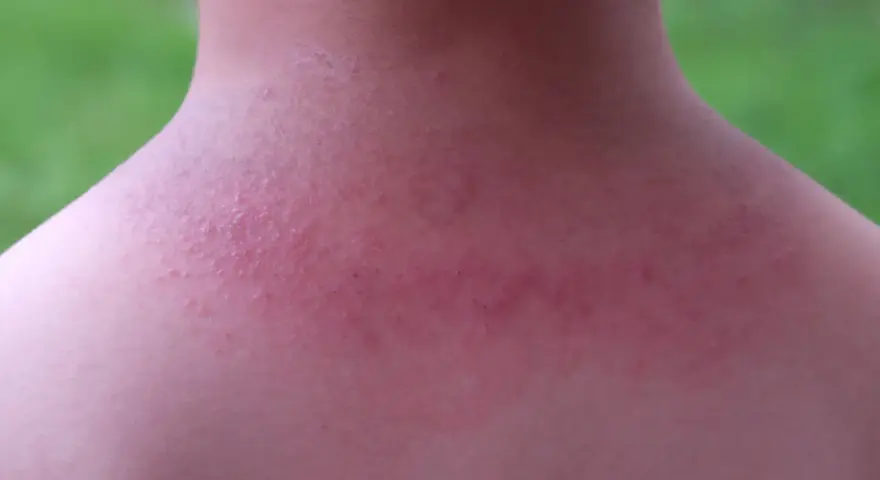 Sarpullido en el cuello, con piel enrojecida y pequeños bultos.