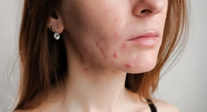 Skóra kobiety po 30. z widocznym trądzikiem hormonalnym na policzku i brodzie. Widoczne zaczerwienienia i wypryski.