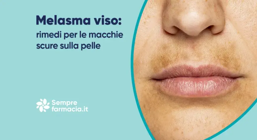 Primo piano del viso con macchie scure sopra il labbro, tipiche del melasma baffetti. Rimedi per le macchie scure sulla pelle.