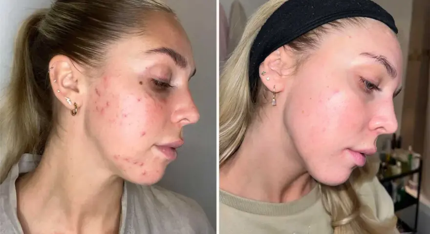 Före- och efterbilder visar en kvinnas hud med hormonspiral akne som förbättrats avsevärt.