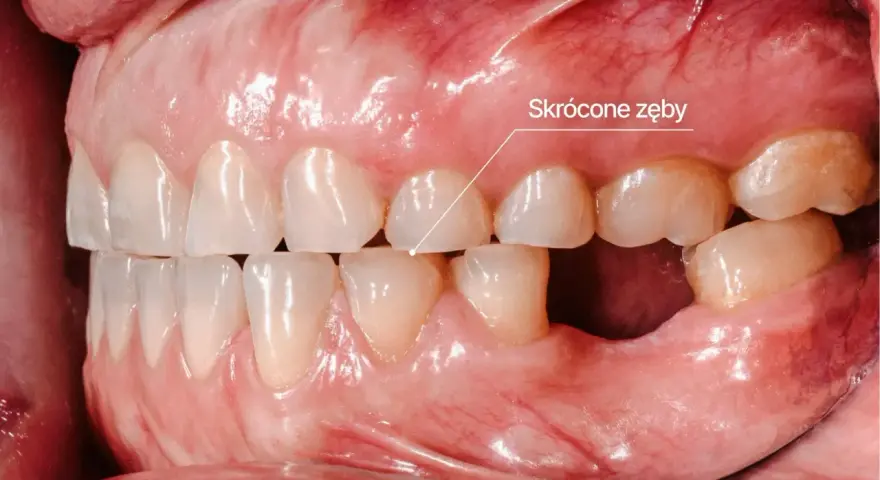Widoczne skrócone zęby, jeden z objawów bruksizmu. Zęby są starte, co może prowadzić do bólu i dyskomfortu.