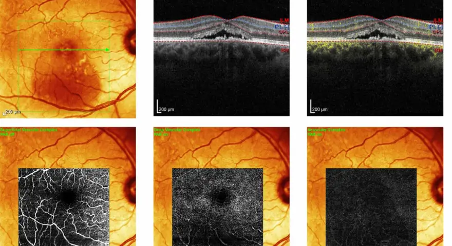 Immagini OCT e IR di un occhio con segni di retinopatia da stress, mostrando alterazioni vascolari e strutturali.