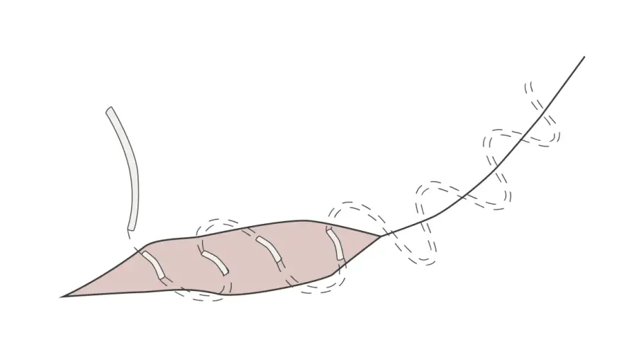 Ilustracja przedstawia szew śródskórny, gdzie nici chirurgiczne są ukryte pod skórą, zapewniając estetyczne gojenie rany.