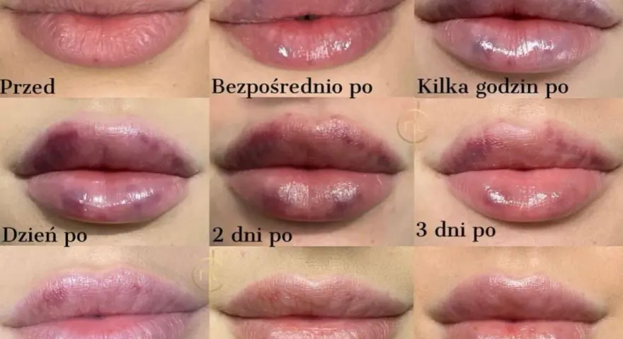 Jak bezpiecznie spać po powiększaniu ust? Porady eksperta