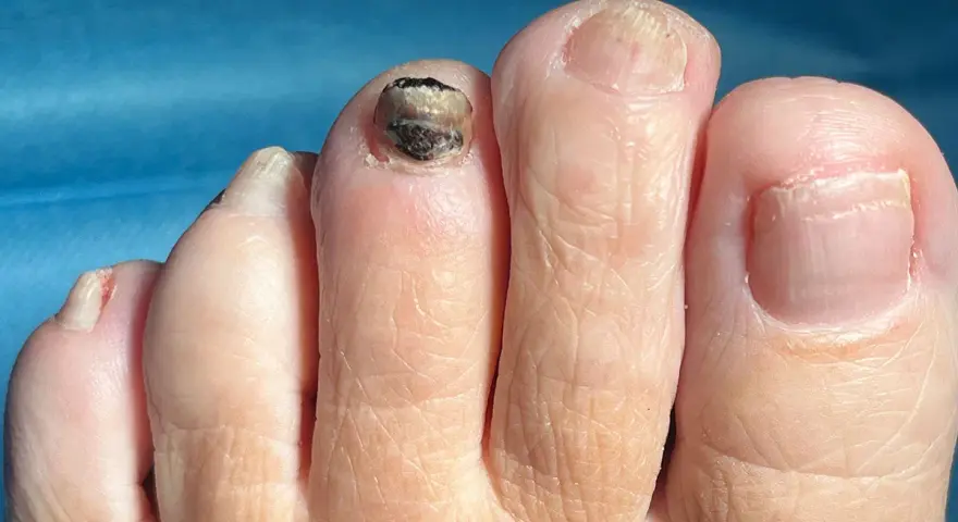Ein Zeh mit einem dunklen bluterguss unter zehennagel. Der Nagel ist stark beschädigt und dunkel verfärbt.