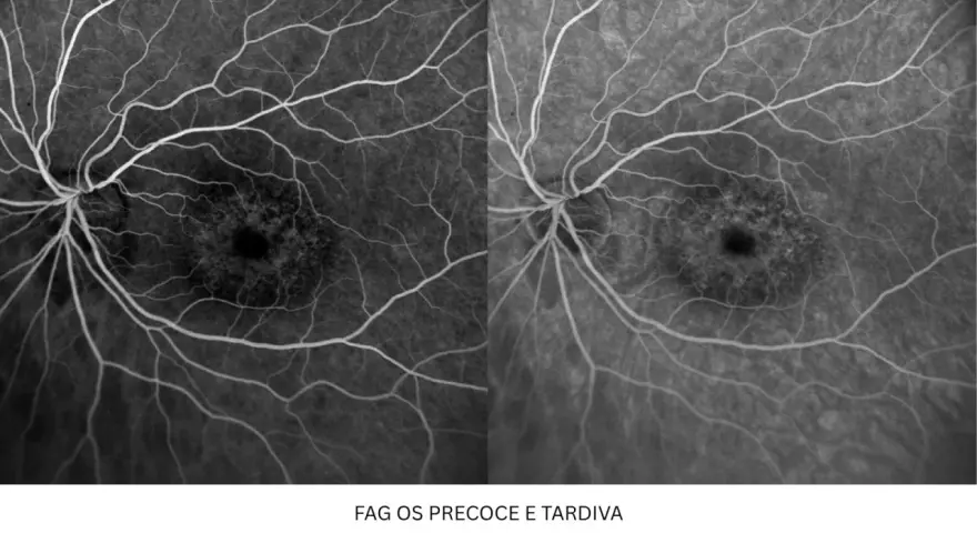 Immagini retiniche con fluoresceina. Possibili effetti collaterali da considerare, ma qui si osservano i vasi sanguigni.
