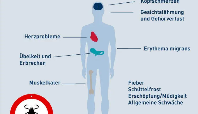Borreliose Symptome: So erkennen Sie die Anzeichen einer Zeckeninfektion
