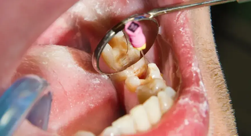 Zgorzel zęba to martwica miazgi. Widoczny ząb w lustrze dentystycznym, z narzędziem w kanale korzeniowym.
