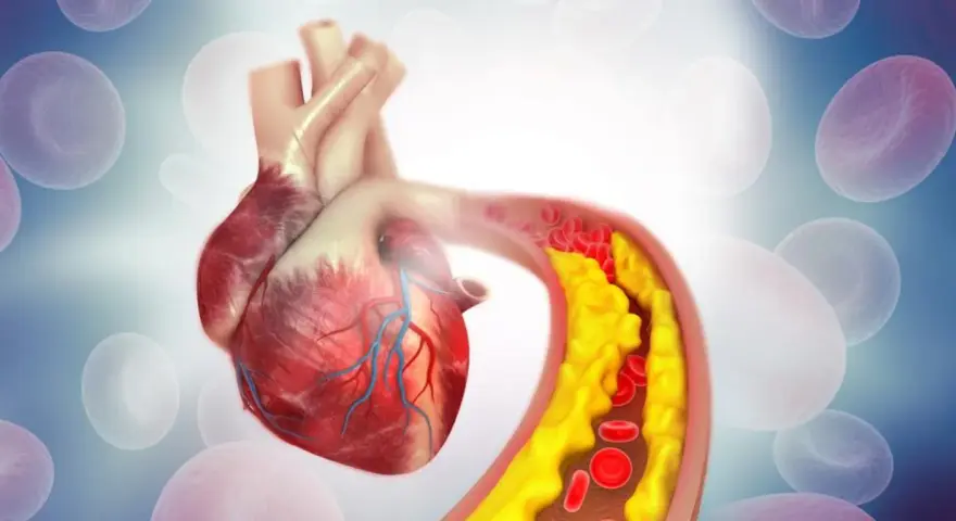 Serce i tętnica z miażdżycą. Żółte złogi cholesterol nie-hdl zwężają naczynie, utrudniając przepływ krwi.