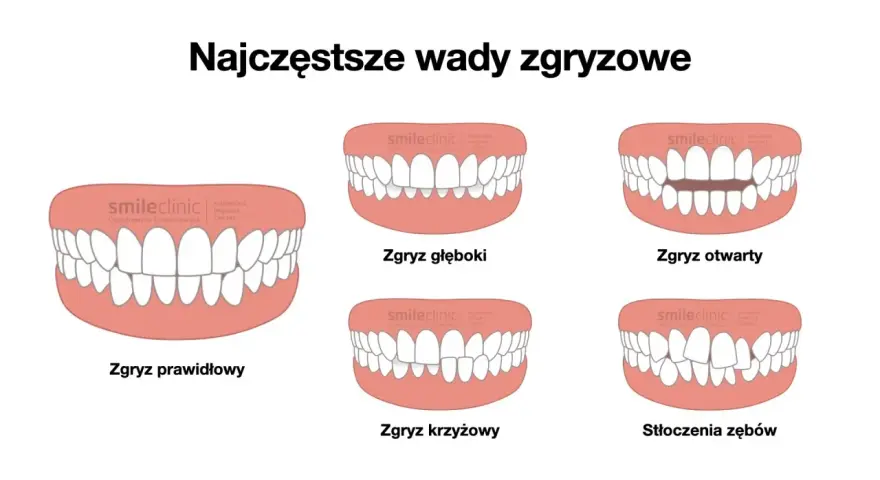 Ilustracja pokazuje różne wady zgryzu: prawidłowy, głęboki, otwarty, krzyżowy i stłoczenia zębów.