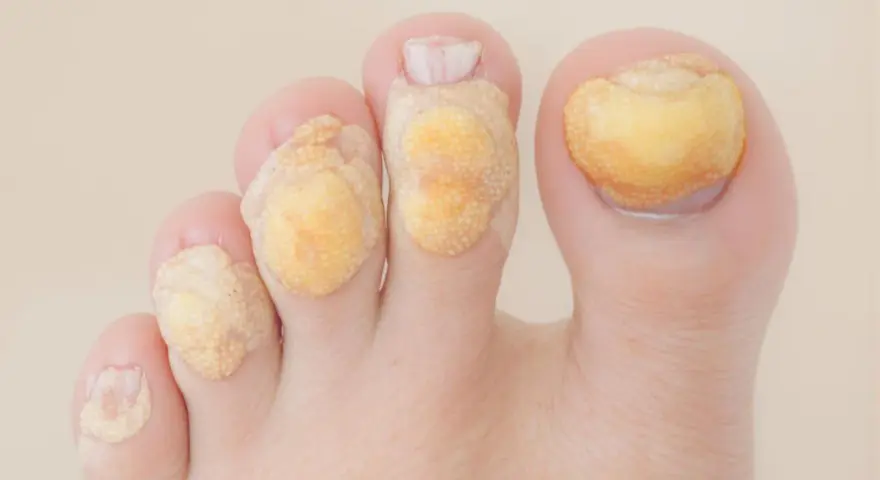 Un gros plan sur un pied avec plusieurs cors sur les doigts de pied, chacun recouvert d'un pansement jaune.