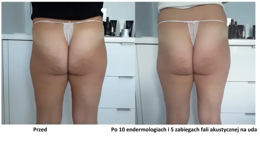Widoczne efekty endermologii po 10 zabiegach i 5 fal akustycznych na uda. Skóra na pośladkach i udach jest gładsza, cellulit zredukowany.