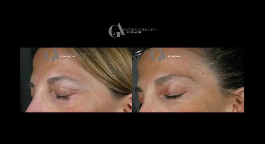 Confronto botox viso prima e dopo: rughe attenuate sulla fronte e contorno occhi più disteso.