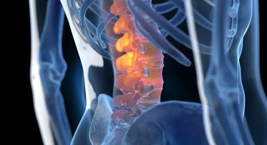 Anatomical rendering of a human spine with inflamed vertebrae, highlighted in orange and red.