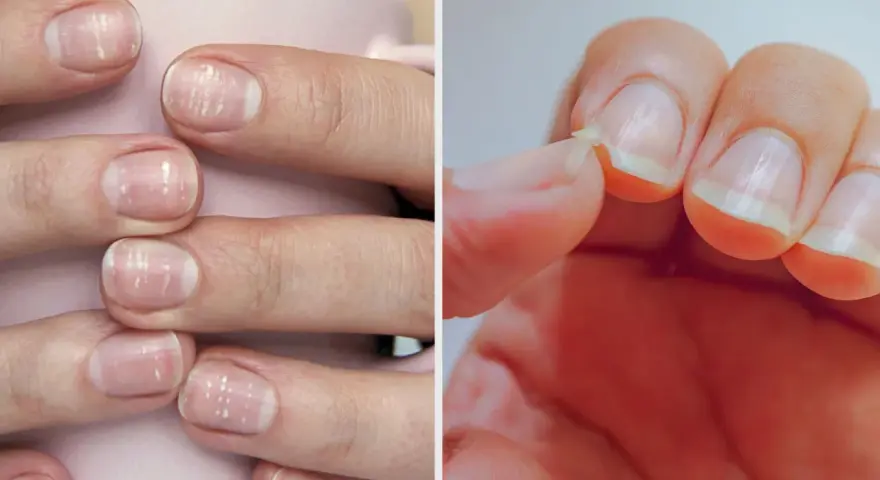 Ongles cassants, striés, manquent de nutriments essentiels. Une main montre des ongles fragiles, l'autre une écaille qui se détache.