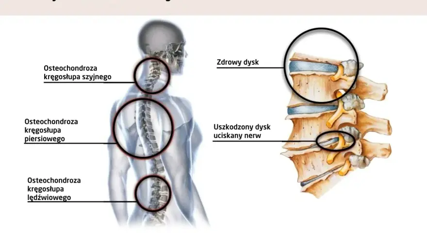 Anatomia kręgosłupa: osteochondroza szyjna może powodować zawroty głowy. Pokazano zdrowy i uszkodzony dysk uciskający nerw.