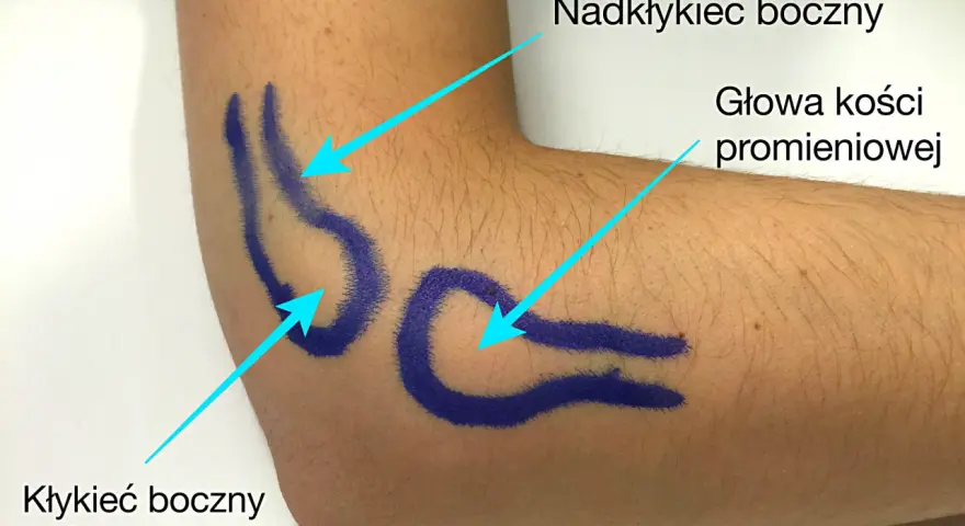 Zaznaczone na niebiesko struktury anatomiczne łokcia: nadkłykieć boczny kości ramiennej, głowa kości promieniowej i kłykieć boczny kości ramiennej.